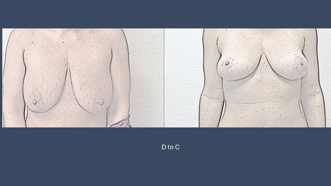 Dr. Suzman Breast lift and red